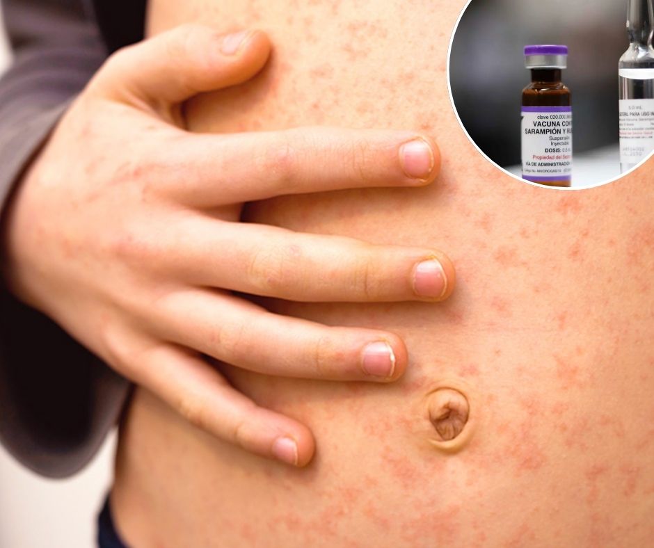 Sarampión en México: 31 muertes y 9,850 contagios en dos años; Jalisco lidera casos