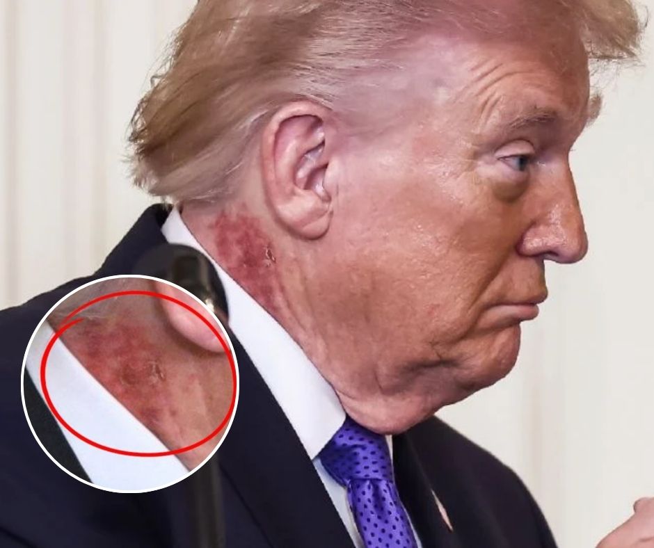 Trump aparece con sarpullido en el cuello; médico atribuye tratamiento preventivo y reaviva atención