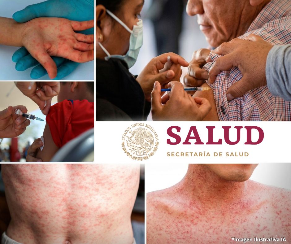 ¡Vacúnate! Sarampión repunta en 2026: Jalisco concentra la mayor carga de contagios